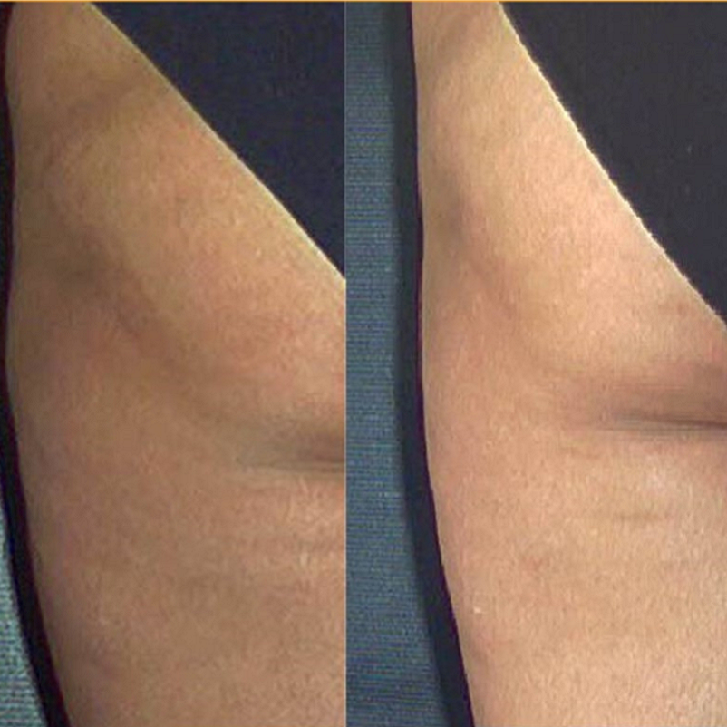 body wrap treatments
