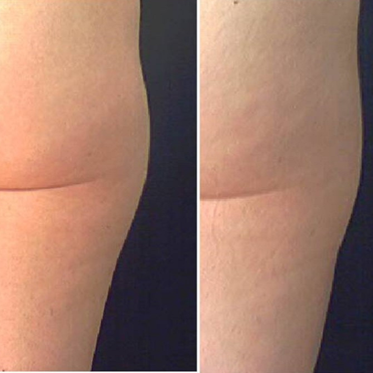 body wrap weight loss