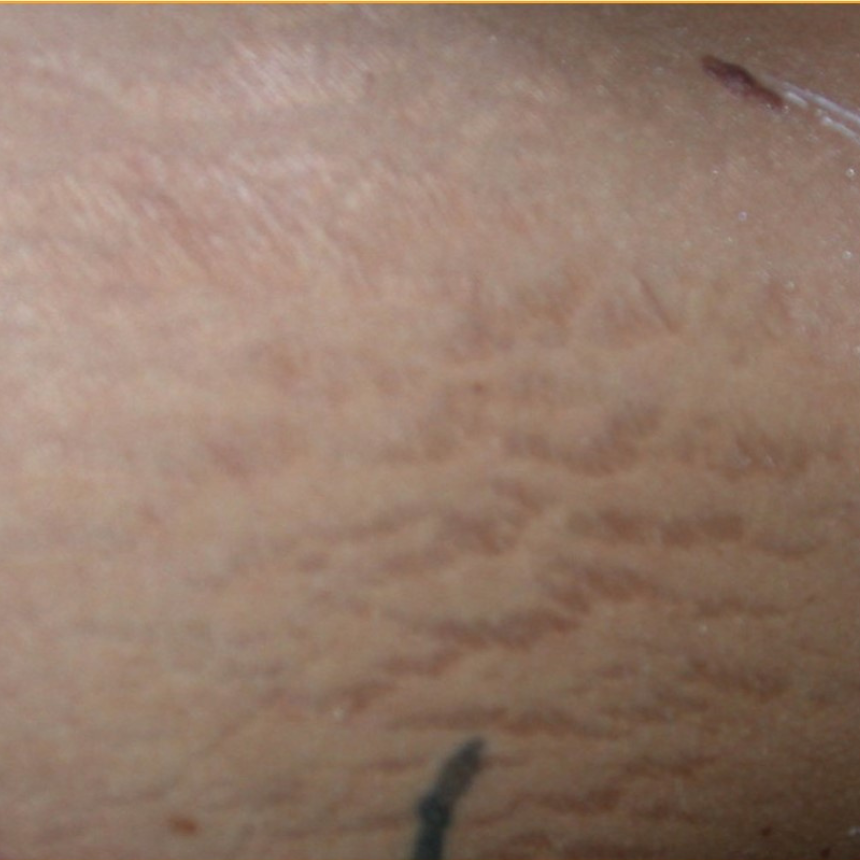 body wraps