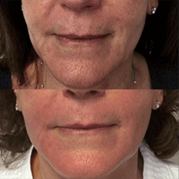 weight loss accupuncture