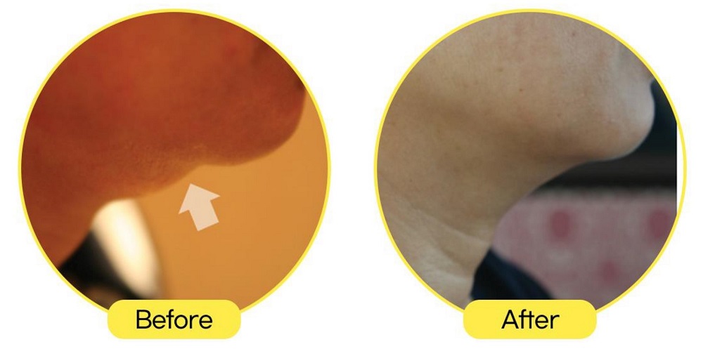silhouette weight loss befor and after