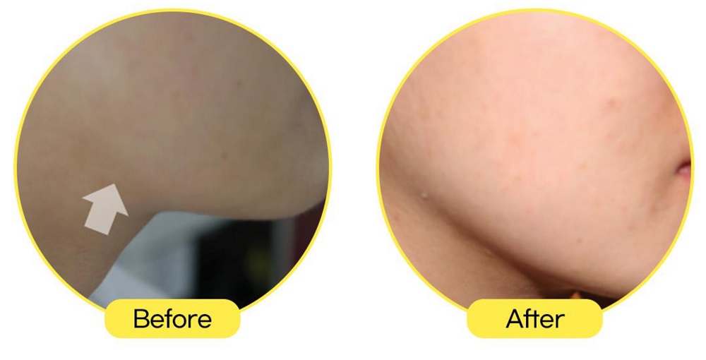silhouette weight loss